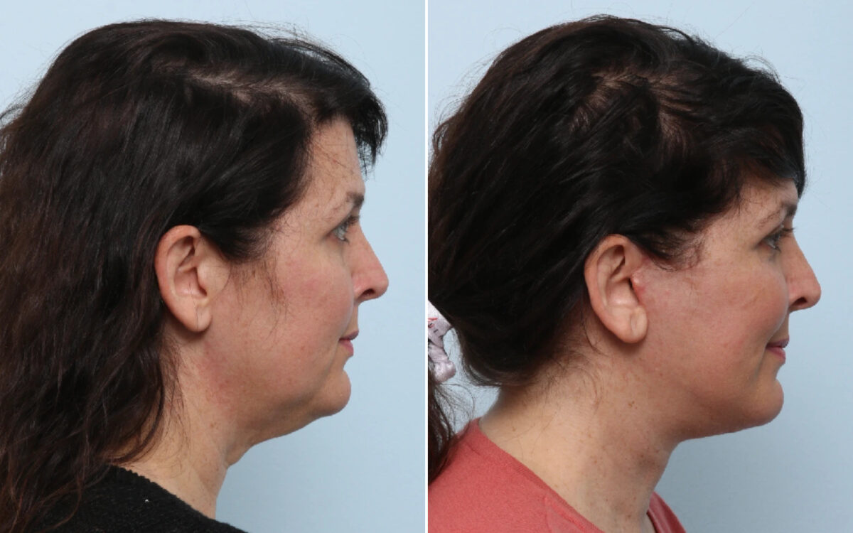 Facelift Before and After Photos in Houston, TX, Patient 86233