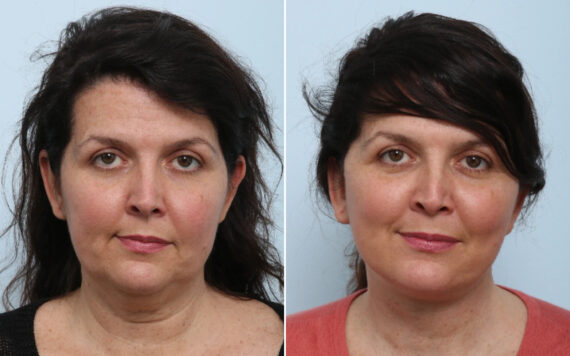 Facelift Before and After Photos in Houston, TX, Patient 86233