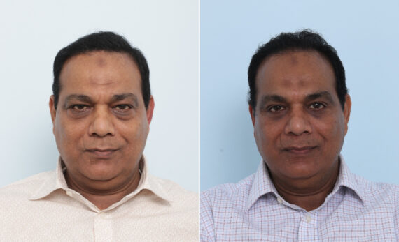 Eyelid Surgery / Blepharoplasty Before and After Photos in Houston, TX, Patient 86003