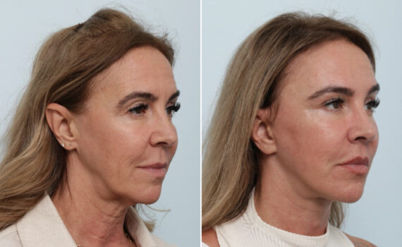 Facelift Before and After Photos in Houston, TX, Patient 86224