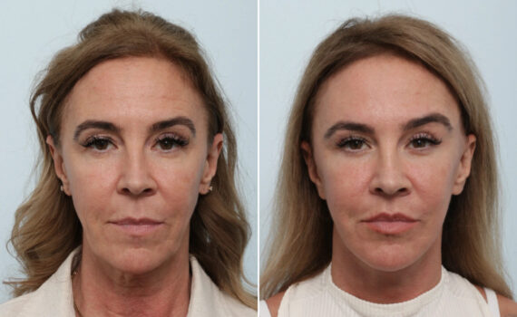 Facelift Before and After Photos in Houston, TX, Patient 86224