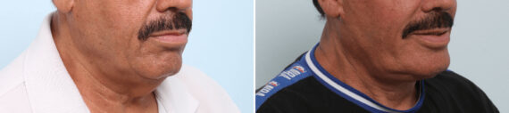 Neck Contouring Before and After Photos in Houston, TX, Patient 86488
