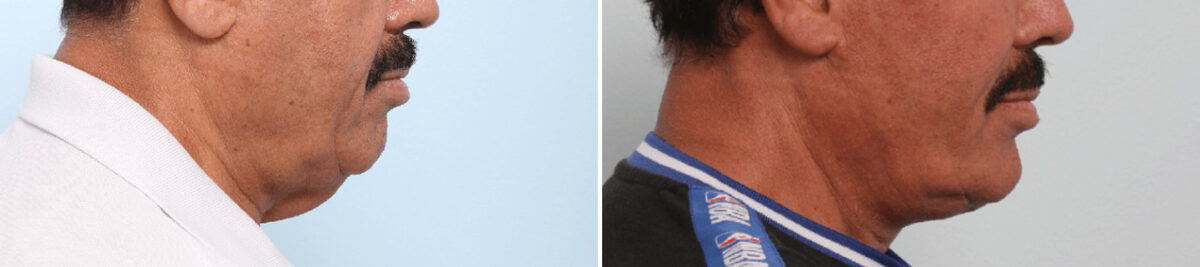Neck Contouring Before and After Photos in Houston, TX, Patient 86488