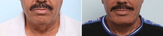 Neck Contouring Before and After Photos in Houston, TX, Patient 86488
