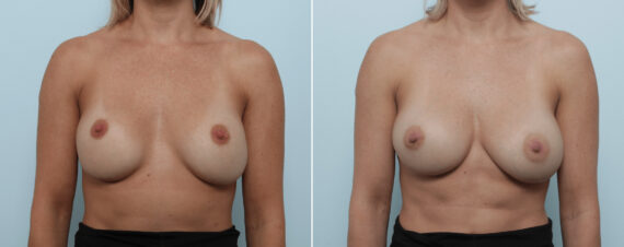 Breast Implant Exchange Before and After Photos in Houston, TX, Patient 86498