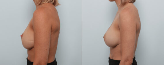 Breast Implant Exchange Before and After Photos in Houston, TX, Patient 86498
