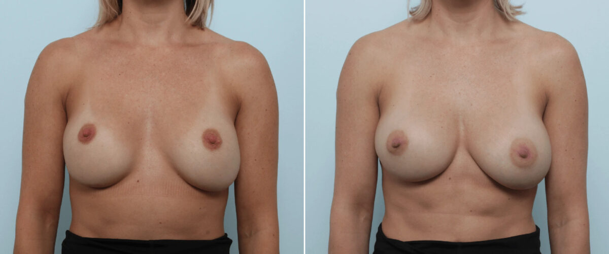 Breast Implant Exchange Before and After Photos in Houston, TX, Patient 86498