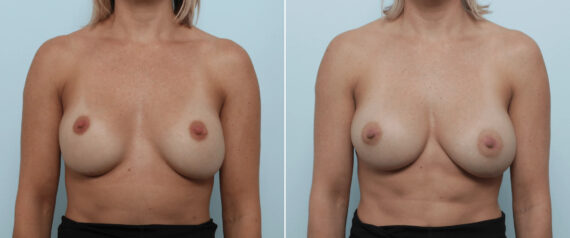 Breast Implant Exchange Before and After Photos in Houston, TX, Patient 86498