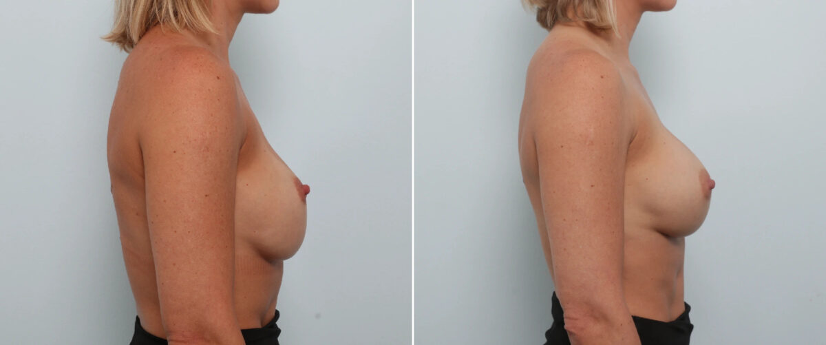Breast Implant Exchange Before and After Photos in Houston, TX, Patient 86498