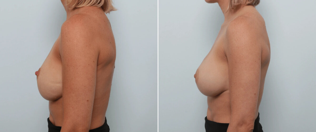 Breast Implant Exchange Before and After Photos in Houston, TX, Patient 86498