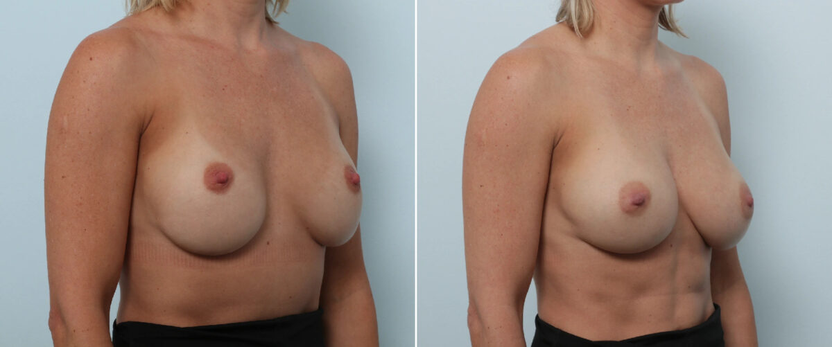 Breast Implant Exchange Before and After Photos in Houston, TX, Patient 86498
