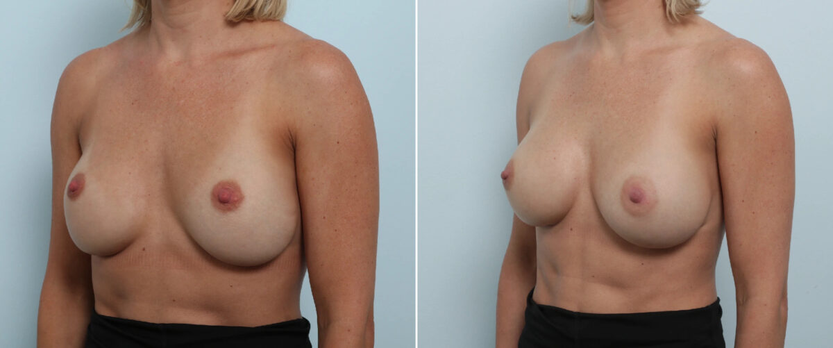 Breast Implant Exchange Before and After Photos in Houston, TX, Patient 86498