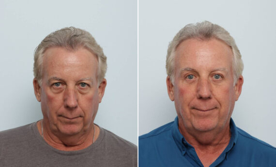 Eyelid Surgery / Blepharoplasty Before and After Photos in Houston, TX, Patient 86510