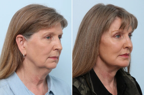Facelift Before and After Photos in Houston, TX, Patient 86622
