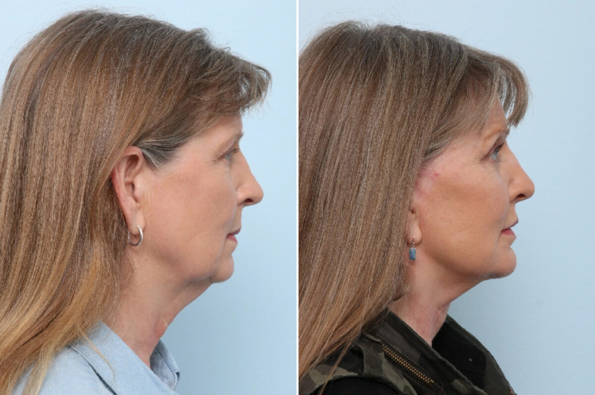 Facelift Before and After Photos in Houston, TX, Patient 86622