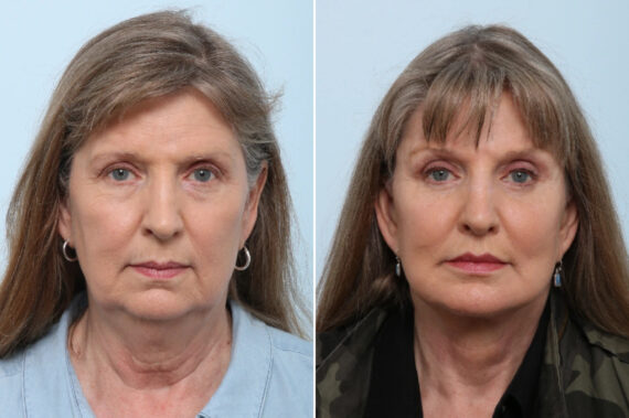 Facelift Before and After Photos in Houston, TX, Patient 86622