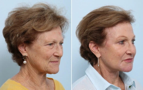 Facelift Before and After Photos in Houston, TX, Patient 86633