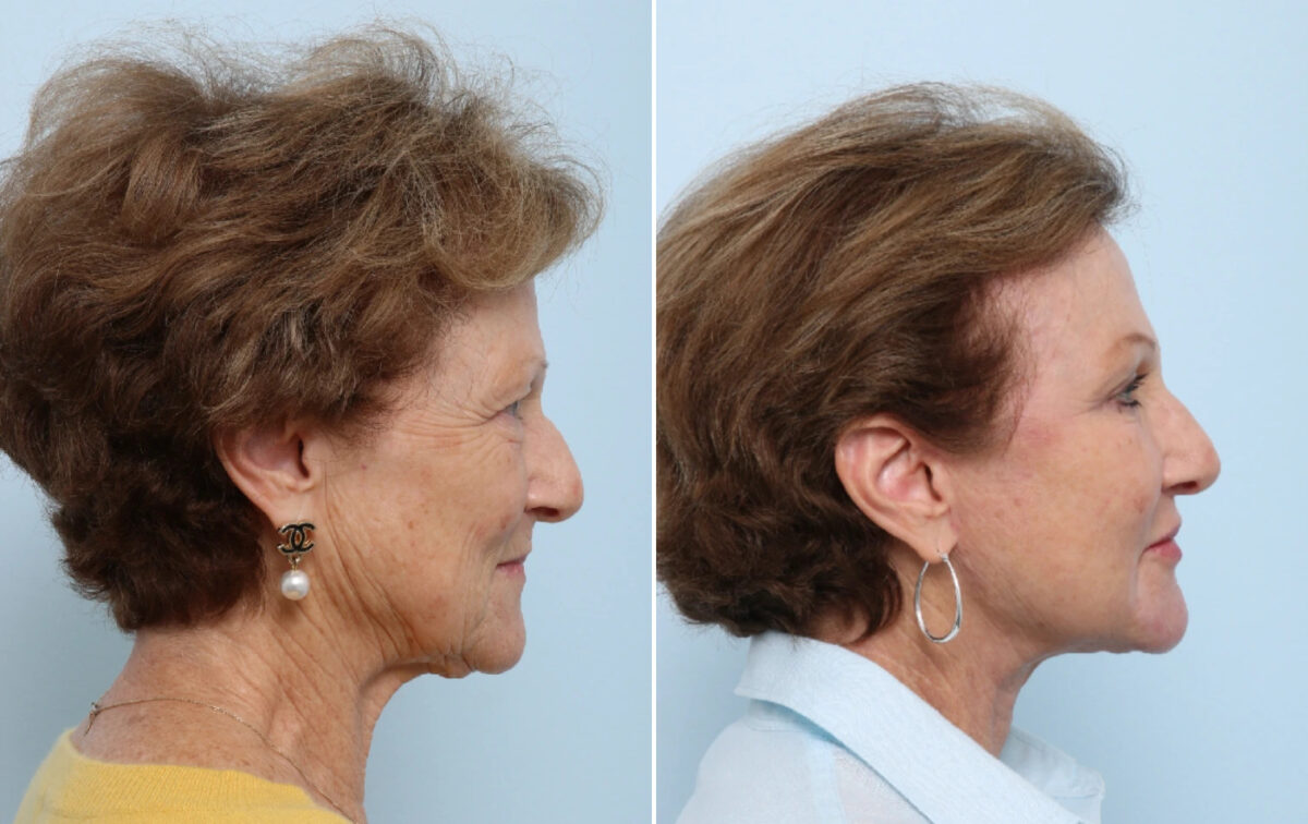 Facelift Before and After Photos in Houston, TX, Patient 86633