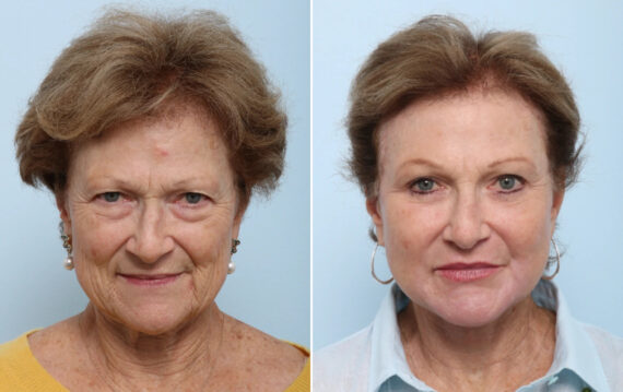 Facelift Before and After Photos in Houston, TX, Patient 86633