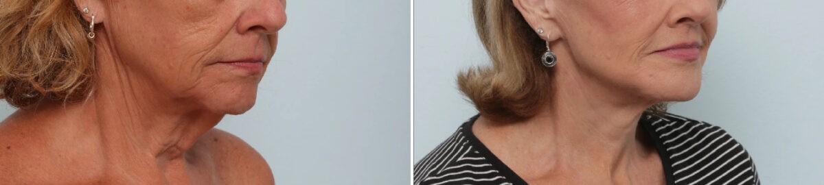 Neck Contouring Before and After Photos in Houston, TX, Patient 86643