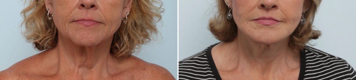 Neck Contouring Before and After Photos in Houston, TX, Patient 86643
