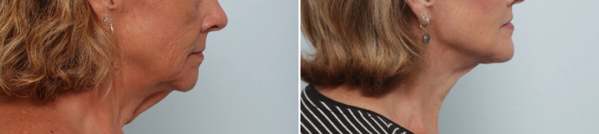 Neck Contouring Before and After Photos in Houston, TX, Patient 86643
