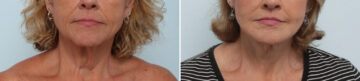 Neck Contouring Before and After Photos in Houston, TX, Patient 86643