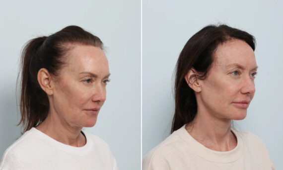 Facelift Before and After Photos in Houston, TX, Patient 86888