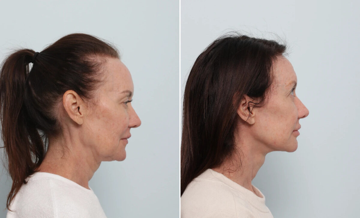 Facelift Before and After Photos in Houston, TX, Patient 86888
