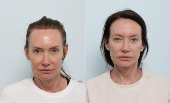 Facelift Before and After Photos in Houston, TX, Patient 86888