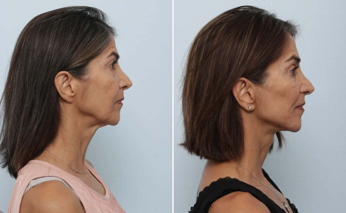 Facelift Before and After Photos in Houston, TX, Patient 86898