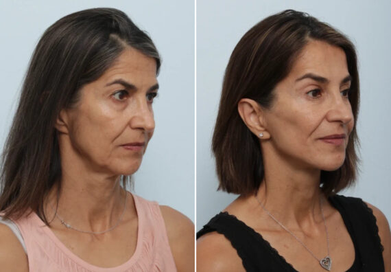 Facelift Before and After Photos in Houston, TX, Patient 86898
