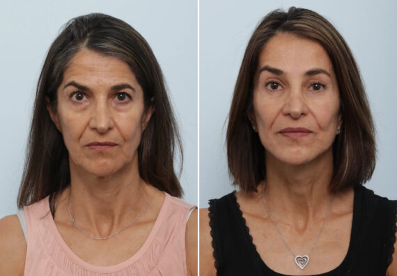 Facelift Before and After Photos in Houston, TX, Patient 86898