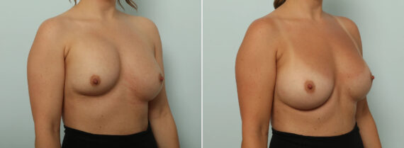 Breast Implant Exchange Before and After Photos in Houston, TX, Patient 86908