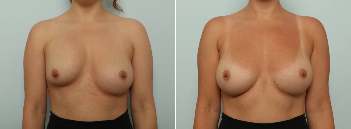 Patient 86908, Breast Implant Exchange Before and After Photos Breast Implant Exchange Before and After Photos in Houston, TX, Patient 86908