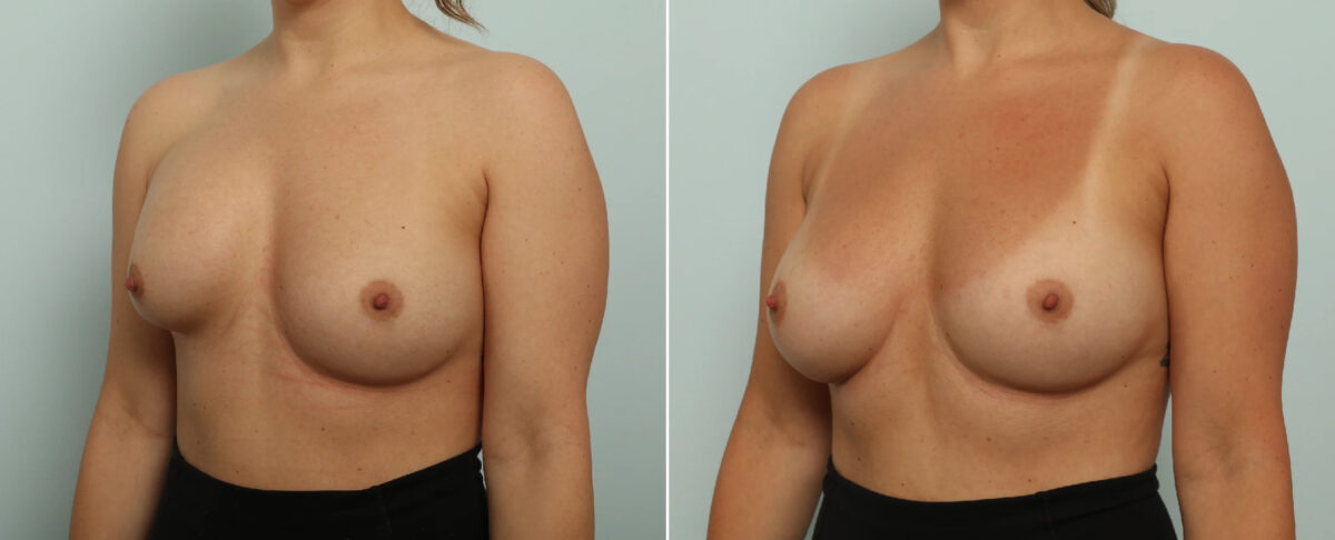 Breast Implant Exchange Before and After Photos in Houston, TX, Patient 86908