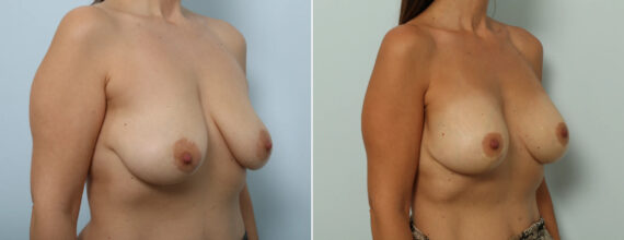 Breast Lift with Augmentation Before and After Photos in Houston, TX, Patient 86918