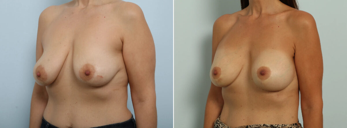 Breast Lift with Augmentation Before and After Photos in Houston, TX, Patient 86918