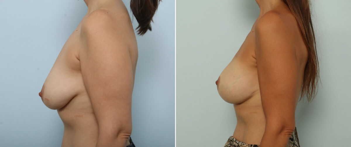 Breast Lift with Augmentation Before and After Photos in Houston, TX, Patient 86918