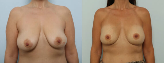 Breast Lift with Augmentation Before and After Photos in Houston, TX, Patient 86918