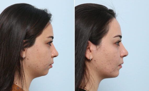 Buccal Fat Pad Removal Before and After Photos in Houston, TX, Patient 86985