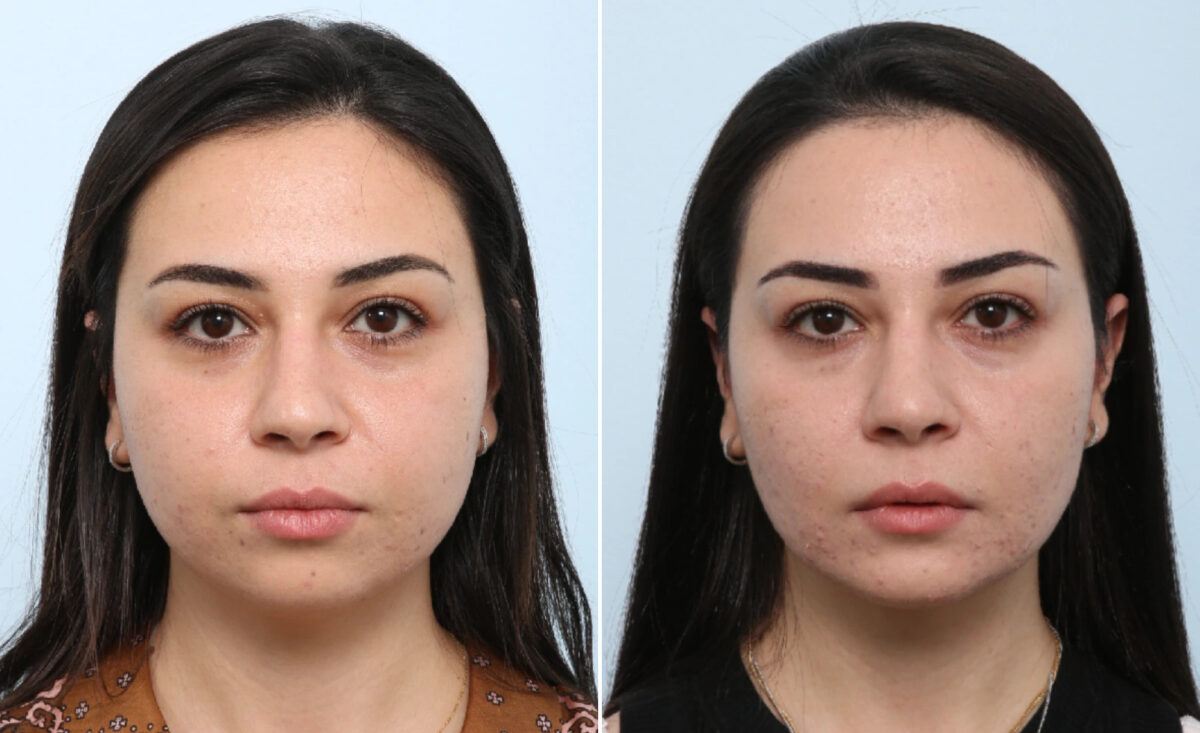 Buccal Fat Pad Removal Before and After Photos in Houston, TX, Patient 86985