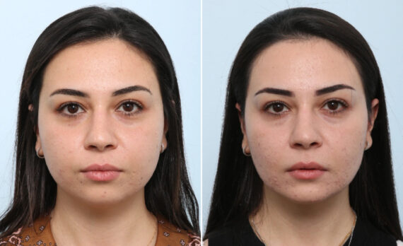 Buccal Fat Pad Removal Before and After Photos in Houston, TX, Patient 86985