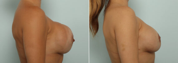 Breast Revision with Strattice Before and After Photos in Houston, TX, Patient 86992