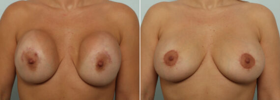 Breast Revision with Strattice Before and After Photos in Houston, TX, Patient 86992