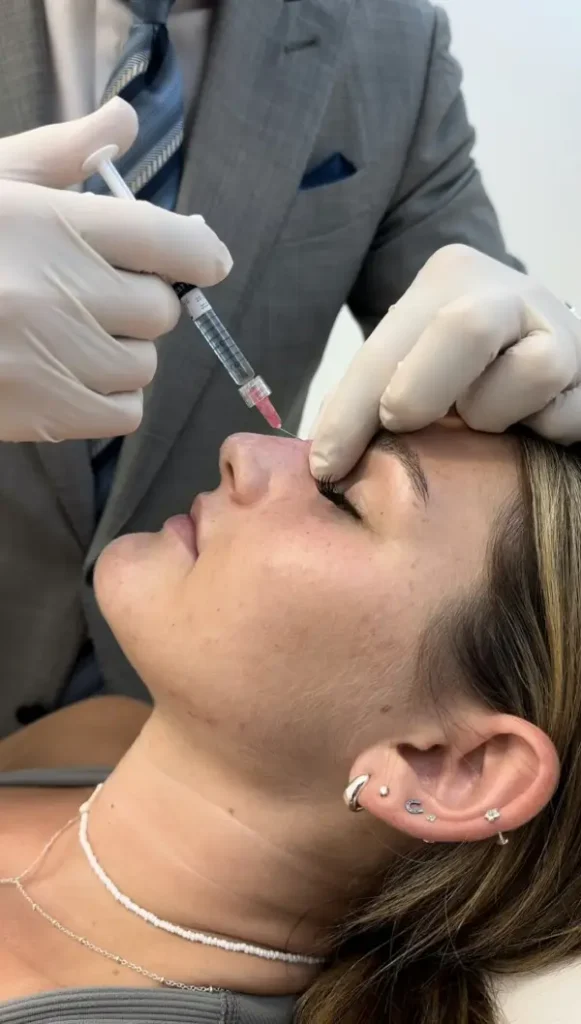 Non-Surgical Rhinoplasty Natural-Looking Results