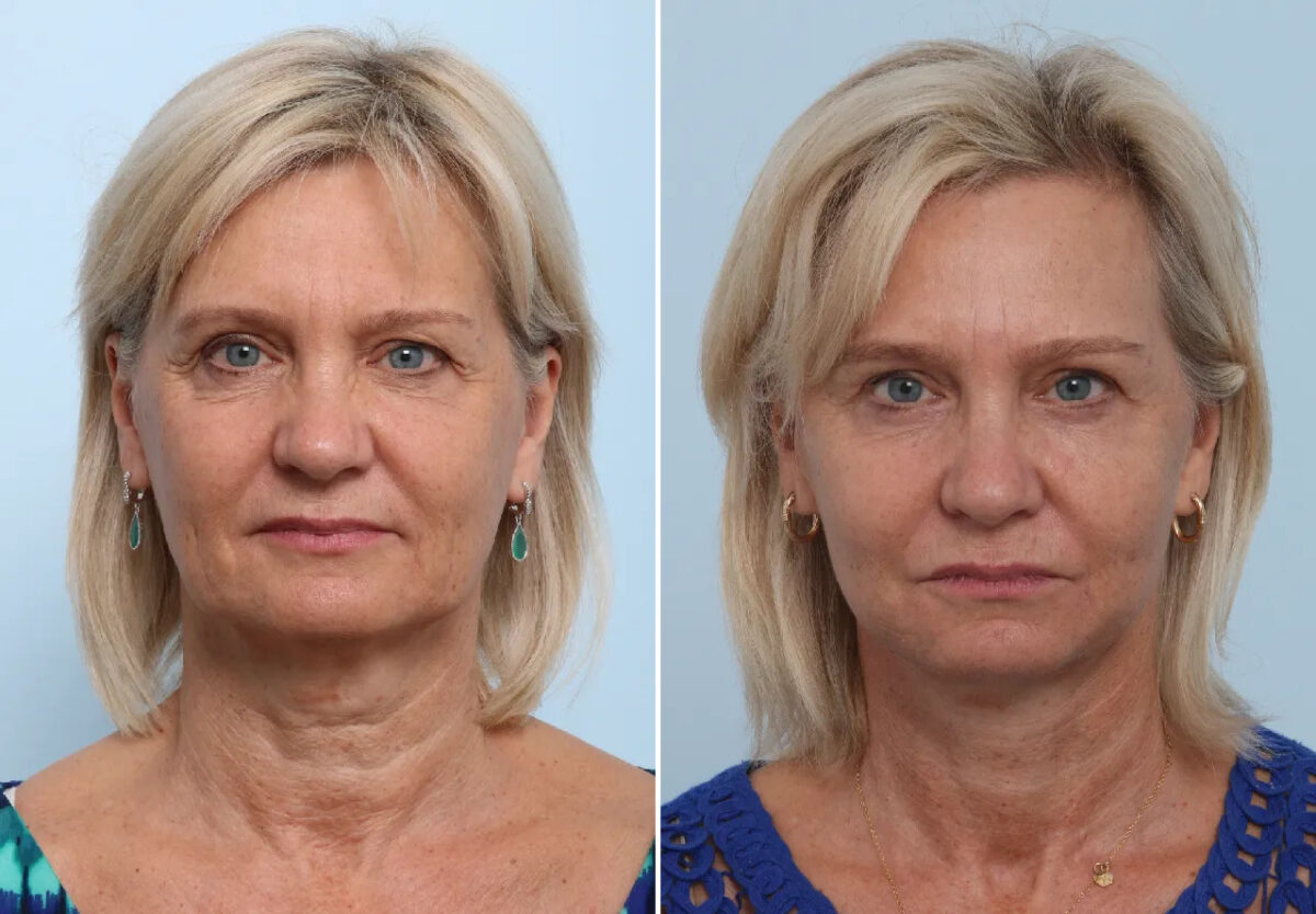 Patient 26610, Eyelid Surgery / Blepharoplasty Before and After Photos Eyelid Surgery / Blepharoplasty Before and After Photos in Houston, TX, Patient 26610
