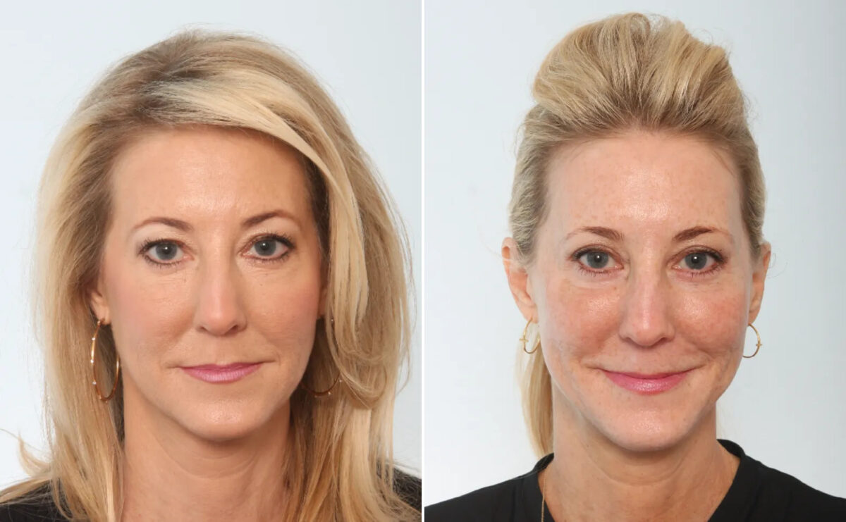 Eyelid Surgery / Blepharoplasty Before and After Photos in Houston, TX, Patient 26613