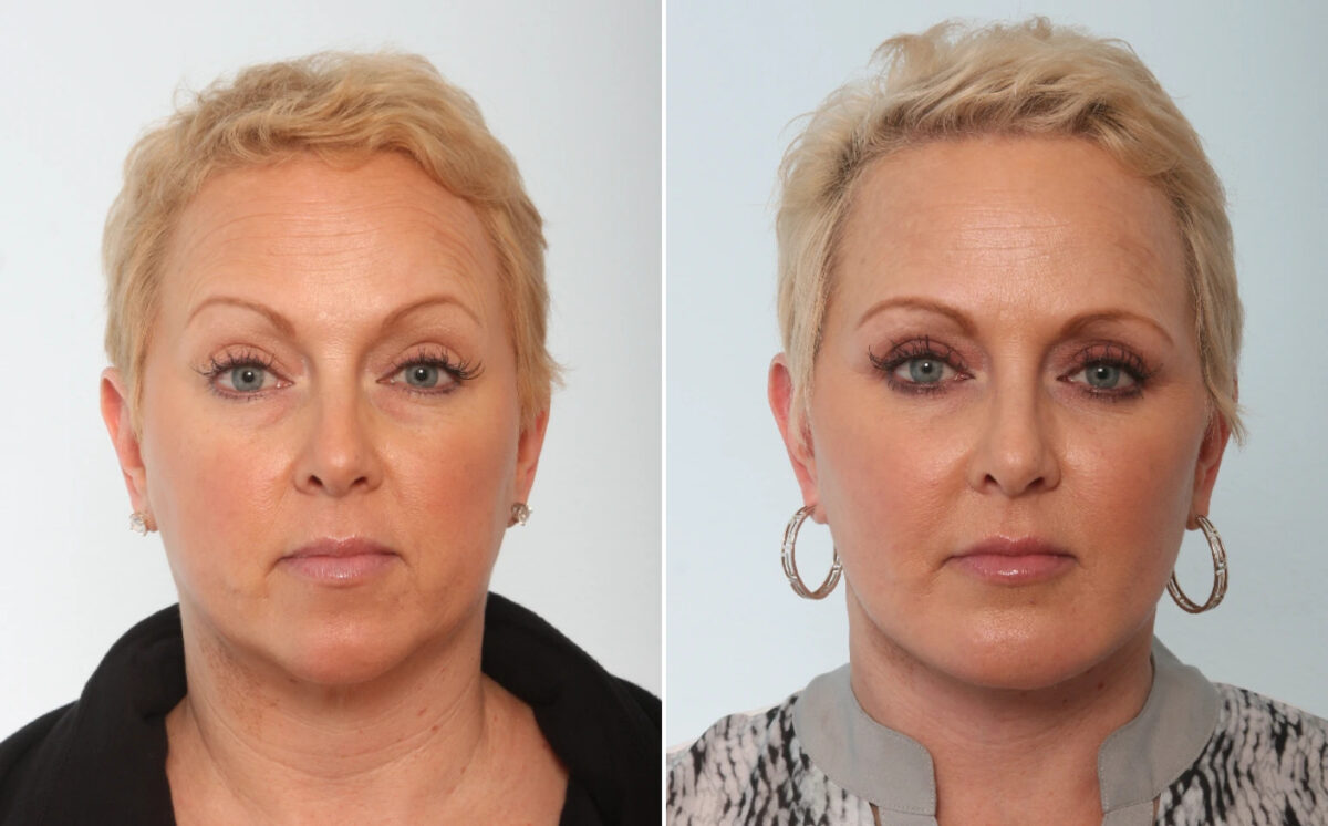Patient 26619, Eyelid Surgery / Blepharoplasty Before and After Photos Eyelid Surgery / Blepharoplasty Before and After Photos in Houston, TX, Patient 26619