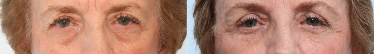 Eyelid Surgery / Blepharoplasty Before and After Photos in Houston, TX, Patient 26649